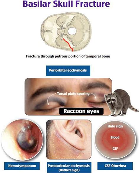 halo sign csf|Basilar Skull Fractures